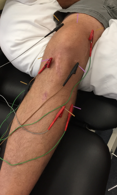 physiotherapy